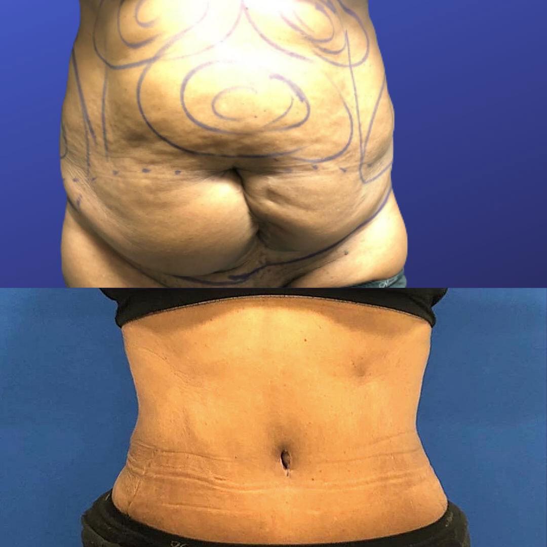 Liposuction NYC: Excellent Choice For Removing Belly Fat